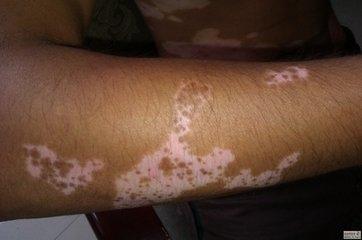 小孩9歲胳膊上許多白斑會(huì)是白癜風(fēng)嗎