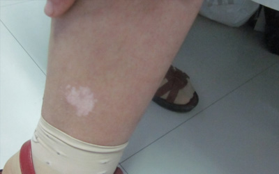 小孩子腿上有一小塊白是白癜風(fēng)