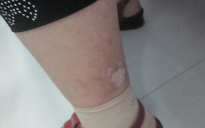 胳膊腿上白斑