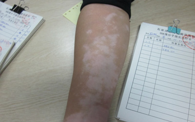 胳膊出現白斑是怎么回事