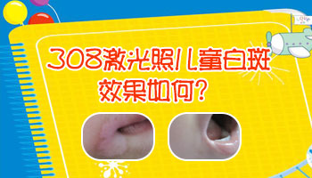 孩子患上白癜風應該怎么治療