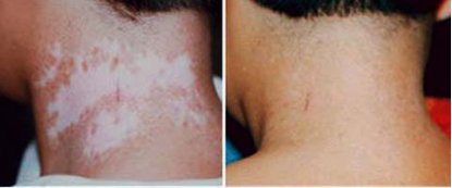 邯鄲白癜風擴散了能治好嗎