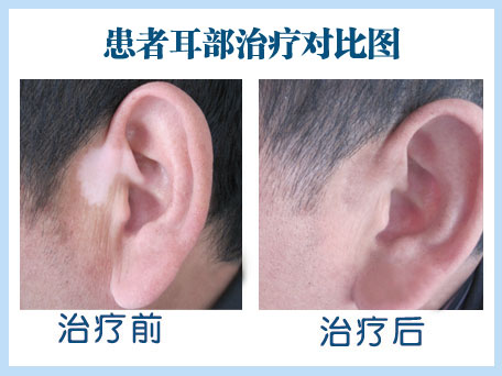 邯鄲治療白癜風多少錢