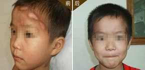 衡水兒童白癜風有哪些癥狀