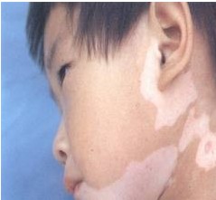 衡水有專治兒童白癜風(fēng)的醫(yī)院嗎