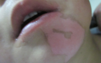 兒童面部白癜風