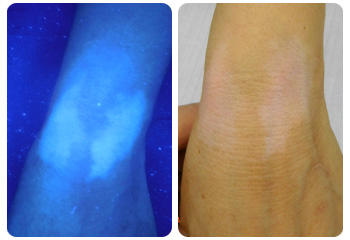 wood燈下，張姐手腕出白癜風(fēng)的癥狀表現(xiàn)