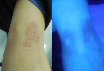 張姐手腕原患處部位黑色素恢復(fù)正常，恢復(fù)健康膚色