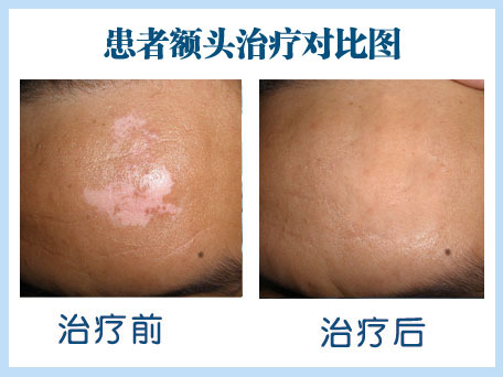 廊坊治療白癜風哪個醫(yī)院好