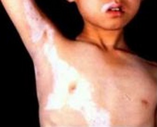 廊坊白癜風與哪些疾病易混淆