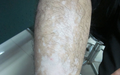 多年白癜風照家用uvb