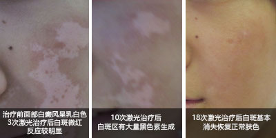 美國極速308nm準分子激光——治療白癜風的核心技術(shù)