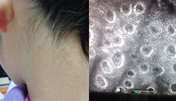 美國極速308nm準分子激光——治療白癜風的核心技術