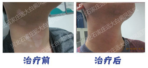 邯鄲臨漳治療白癜風(fēng)的特色療法有什么?