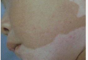 兒童白癜風去哪家醫院治療比較好?