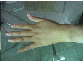 靜止期白癜風(fēng)治療衡水哪家醫(yī)院好?