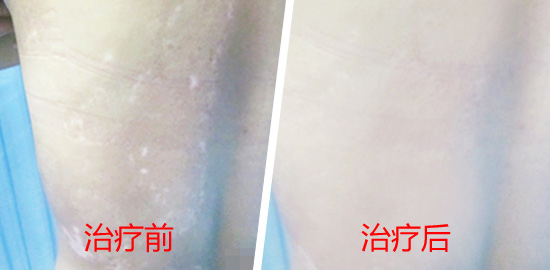 腰上白點又多了，是白癜風嗎？