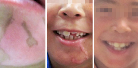 迎六一*兒童白癜風(fēng)惠民普查公益活動開啟