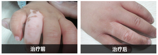 青少兒祛白康復(fù)實(shí)例