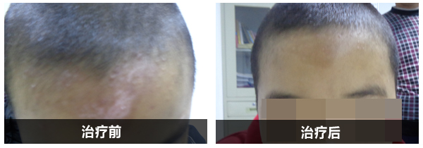 青少兒祛白康復(fù)實(shí)例