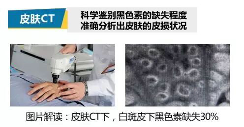 暑期白癜風專項普查