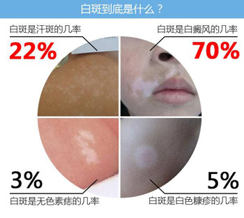 暑期白癜風專項普查