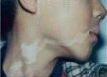 男性嘴角發生白癜風的原因