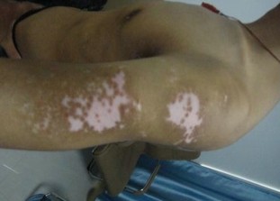 男性白癜風在石家莊怎么治好