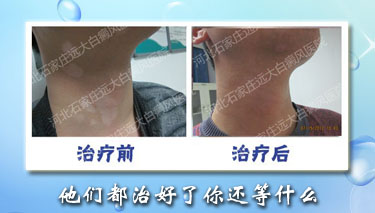 男性背部白癜風多年，如何治療比較好？