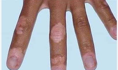 女性散發型白癜風可以用什么方法控制病情?