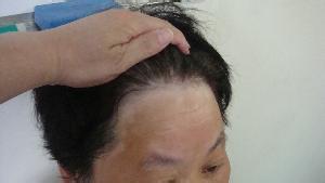 常見的導致女性患上白癜風的因素有哪些呢