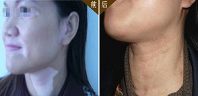 女性更容易患白癜風(fēng)的原因是什么