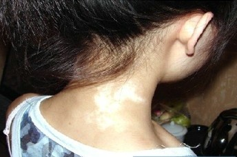 女性得了白癜風(fēng)會不會傳染