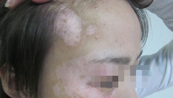 預(yù)防女性白癜風(fēng)