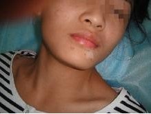 女性臉部白癜風的治療方法