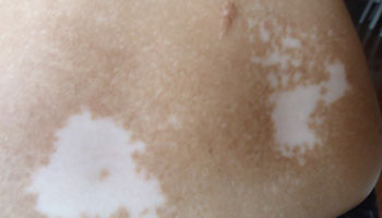 早期白斑如何科學(xué)治療