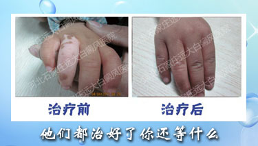 女性白癜風患者調節內分泌的方式是什么