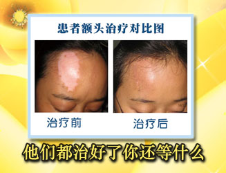 女性白癜風治療注意什么