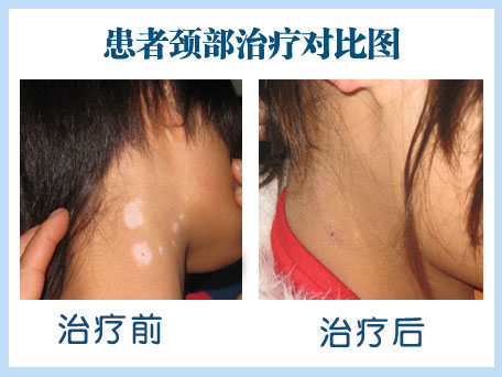 女性頸部白癜風(fēng)激光治療行不行
