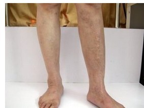 青少年腿部白癜風(fēng)該怎么辦呢