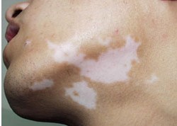 青少年面頸部白癜風為什么比較好治療