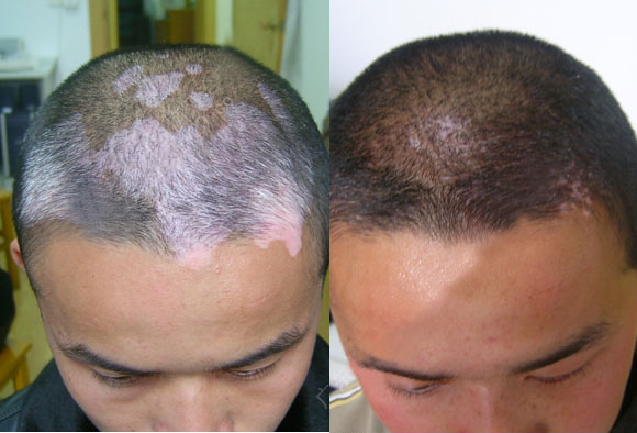 青少年額頭長白點是白癜風嗎