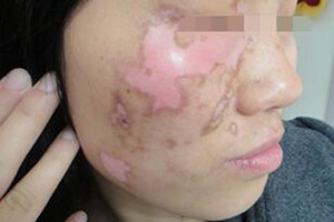 青少年外傷導致白癜風怎么辦