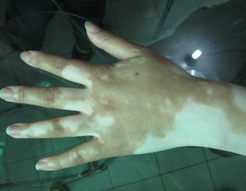 唐山手上白癜風患者應該注意啥