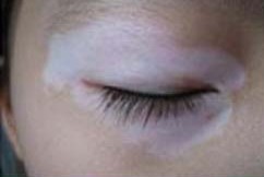 唐山治臉部白斑