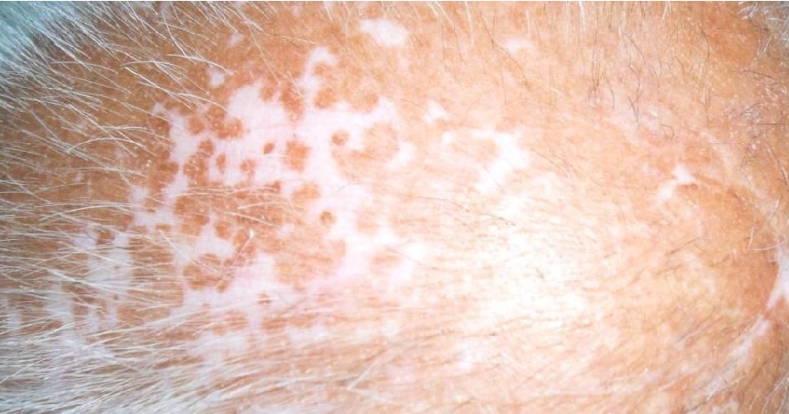 唐山治療老年白癜風效果好的醫院