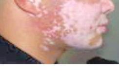 白癜風(fēng)的潛在危害，白癜風(fēng)會引發(fā)哪些病癥?