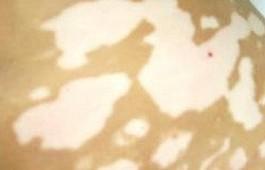 白癜風(fēng)對(duì)病人的危害有哪些?