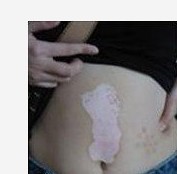 女性有腹部白癜風產生的危害大不大?
