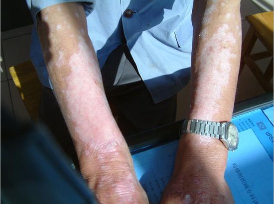 白癜風會不會引起患者免疫力下降?